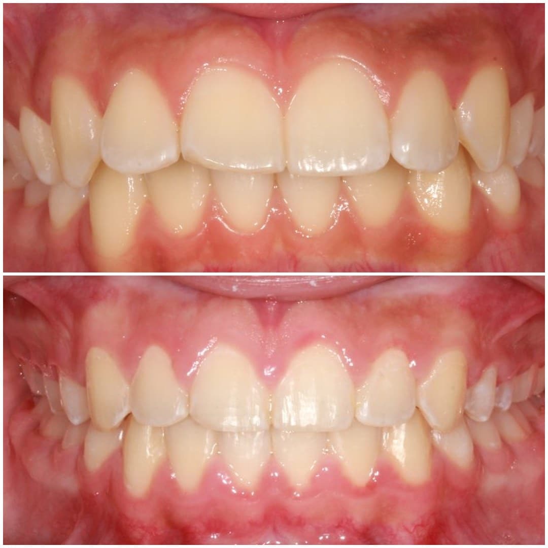 Before and after braces, front view of teeth: flared upper front teeth corrected, Case 1 – Mann Orthodontics